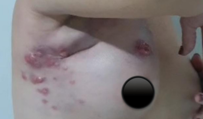 tratamento cancer de mama