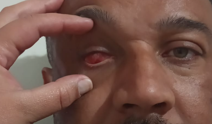 Prótese Ocular irmão Renato