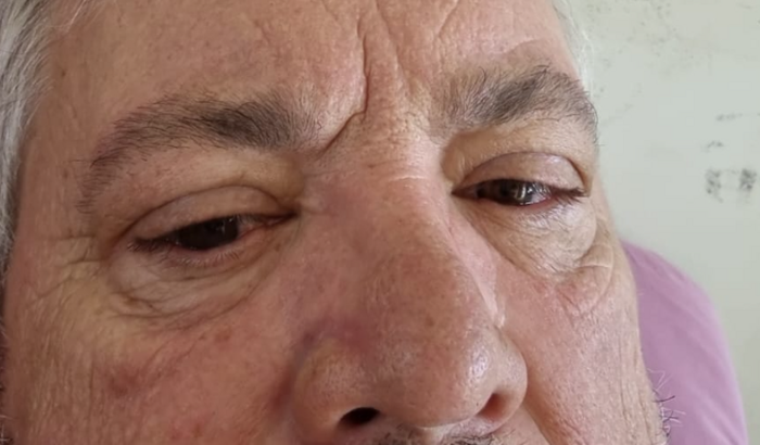 Transplante de córnea