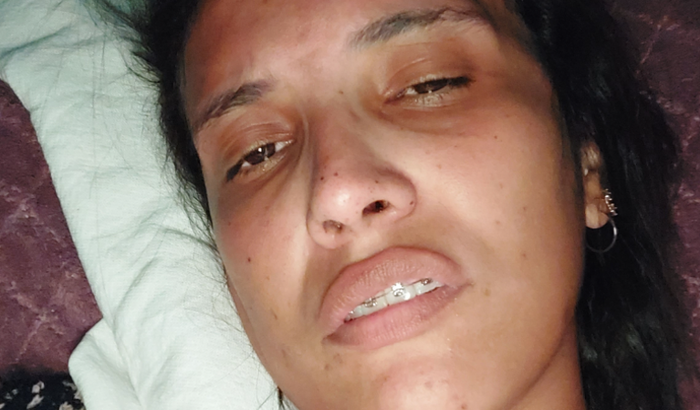 Tratamento cirúrgico para Neuralgia do trigêmeo