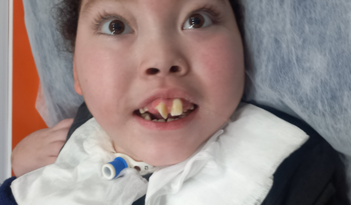 Tratamento pós traqueostomia do Natan