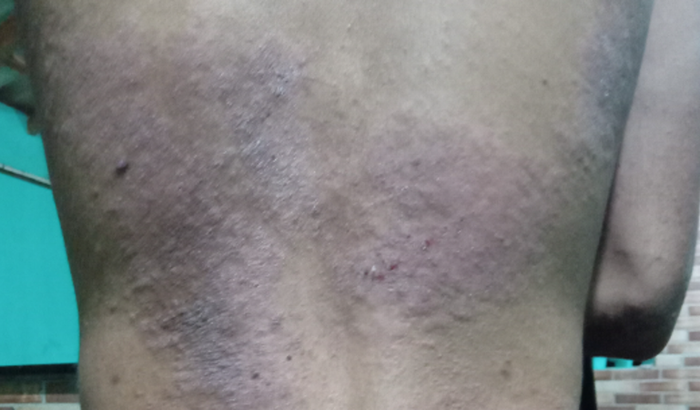 Sofro de uma Doença rara chamada Dermatite Atopica Severa com traços da Benfic