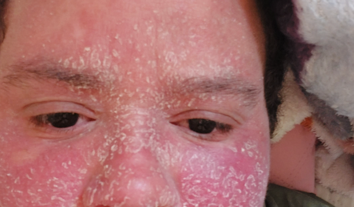 rennycely tratamento sindrome de sezary