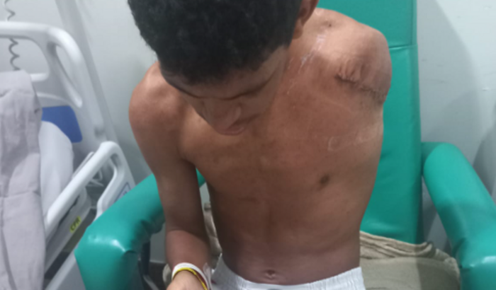 PRÓTESE DE BRAÇO - PRECISO DA SUA AJUDA! TODOS PELO MARCOS