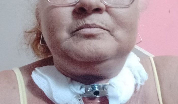Preciso operar o edema reinke