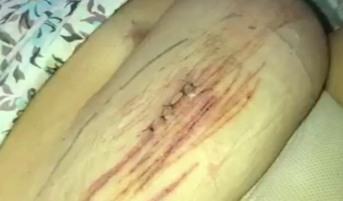 Fazer uma cirurgia de retirada de trompas e ovario