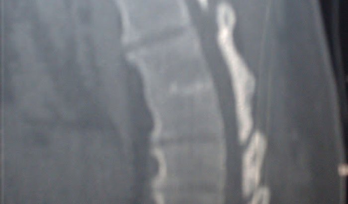 Cirurgia da Coluna
