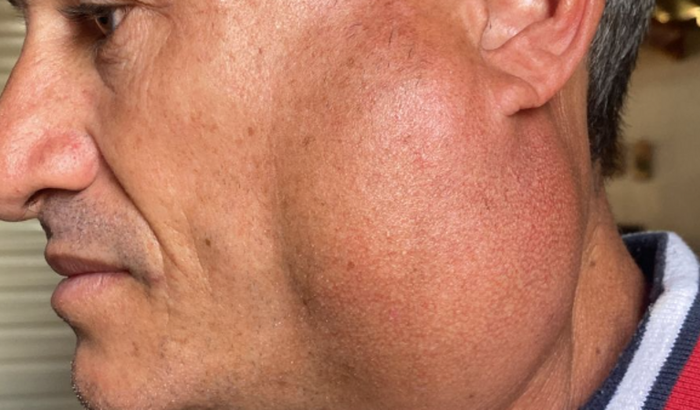 Síndrome de Madelung, preciso fazer a cirurgia urgente!