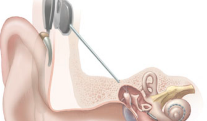 Implante coclear pra Selina Franco Bevilaqua