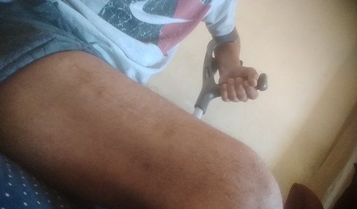 AJUDA PRA CERURGIA PRA MATHEUS, SOFRI UM ACIDENTE DE MOTO E FIQUEI DEFICIENTE.
