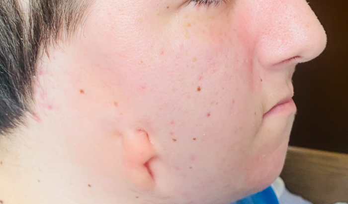 Cirurgia para fazer uma orelha - neo-otoplastia