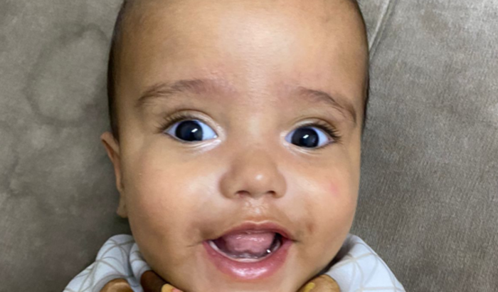 Malformação rara no cérebro