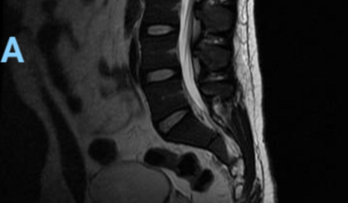 Abscesso do Psoas