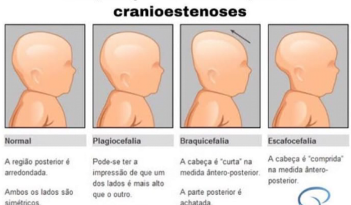 Cirurgia Do Henry Samuel (ESCAFOCEFALIA TARDIA)