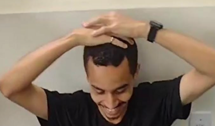 TRANSPLANTE CAPILAR DO FUBAS