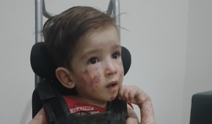 tratamento células troncos e andador e orteses