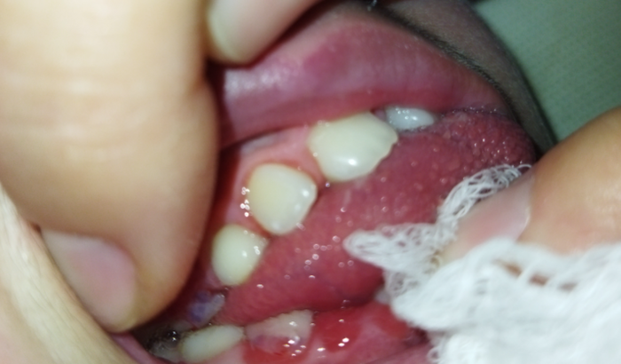 Cuidados contínuo do Pedrinho. 