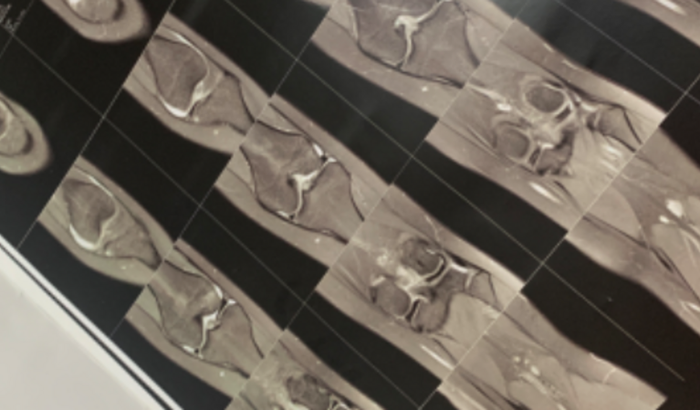 Para minha cirurgia no joelho