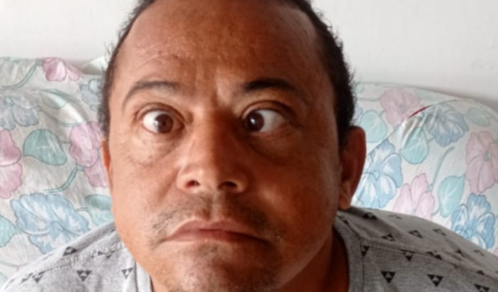 Cirurgia de Tireodiopatia e Orbitopatia Grave