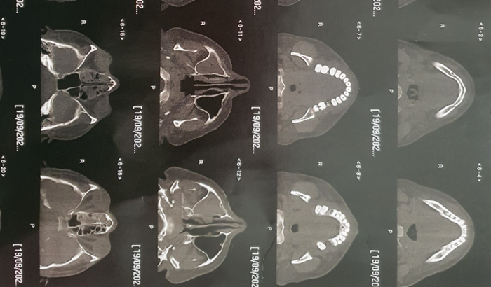 Cirurgia bocal e tratamento da infecção bacteriana no cérebro