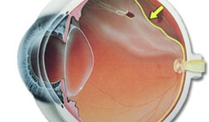 Cirurgia Oftalmologia