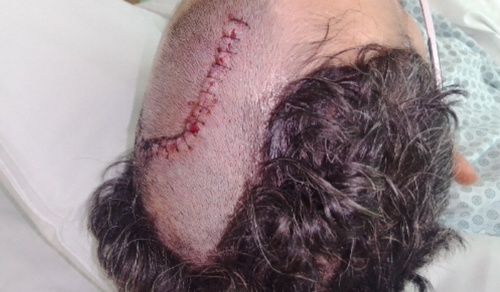 Tratamento de glioblastoma grau 4 em São Paulo