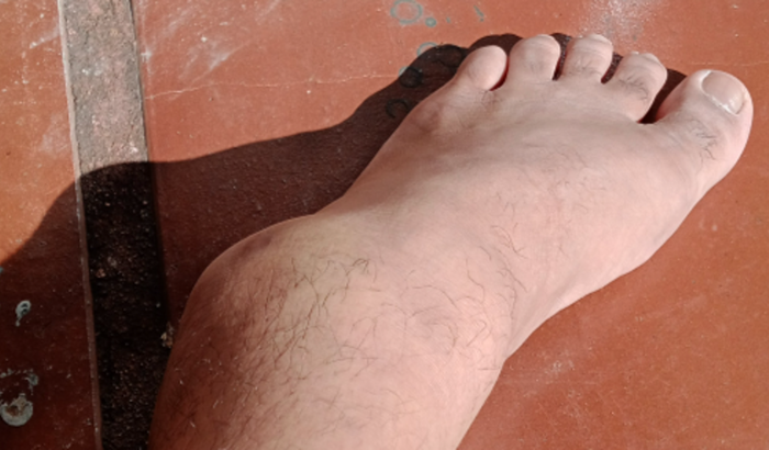 Cirurgia de tornozelo