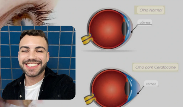 Cirurgia Zenon - Correção de ceratocone nos 2 olhos