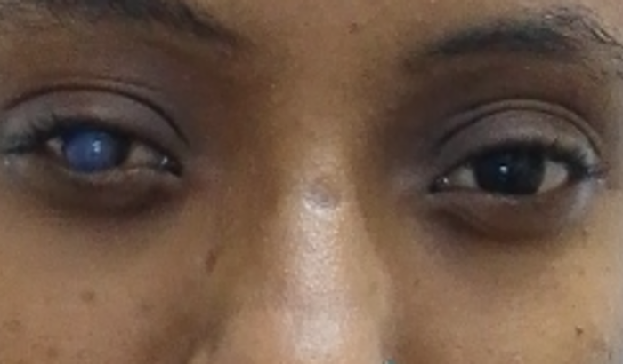 Ajuda para a compra das lentes especiais e tratamentos