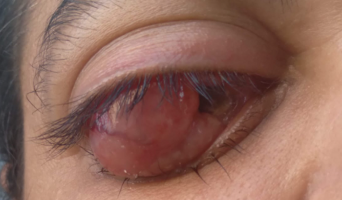 Para o tratamento nos olhos