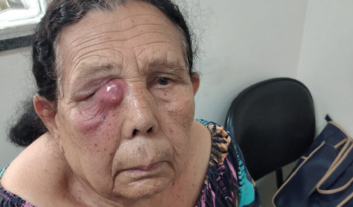 AJUDA PARA CIRURGIA DE DACRIOCISTORRINOSTOMIA A DIREITA. URGENTE