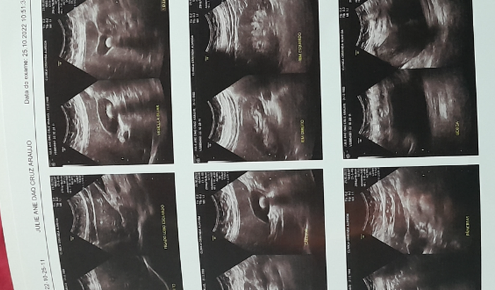 Cirugia da vesícula em hospital com mais recursos