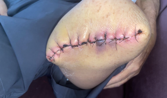 Diabetes vs recuperação do meu sogro