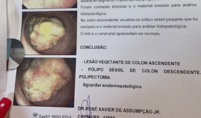 Cirurgia e tratamento de Pólipo séssil de cólon (câncer no intestino) da minha mãe , a Dona Rosane ❤️