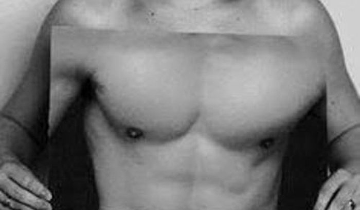 Mastectomia do Louis