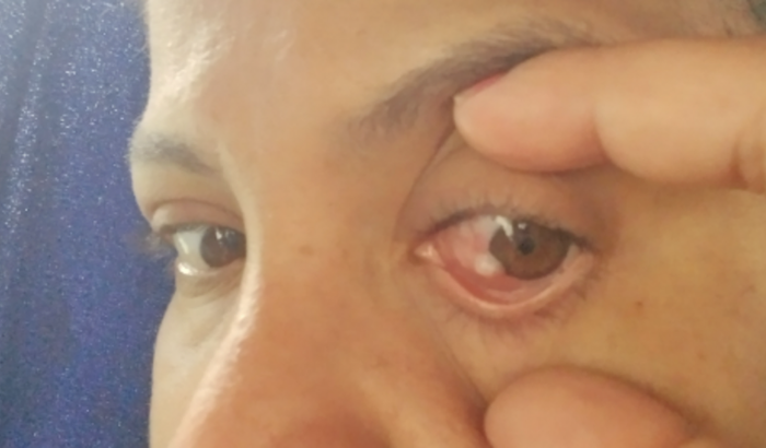 Me ajude a ir para são Paulo fazer o tratamento de um carcinoma no olho