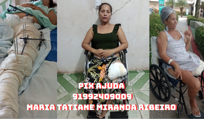 Ajuda para comprar uma Prótese Transfemural bilateral