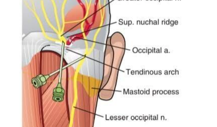 CIRURGIA NERVO OCCIPITAL - CRÂNIO