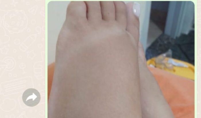 Ajuda para comprar aparelho neuroestimulador medular