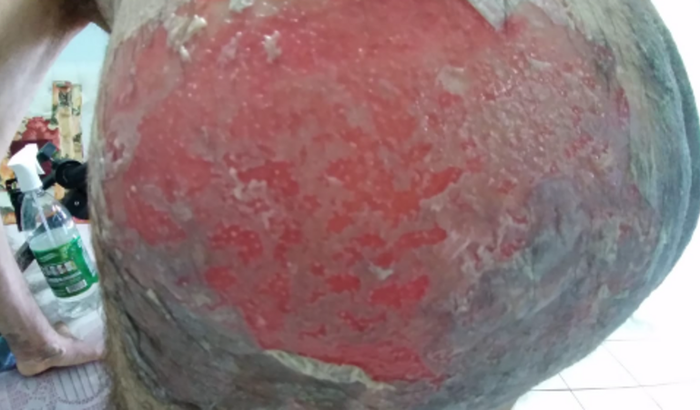 Tratamento Pênfigo Vulgar