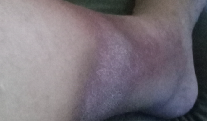 Para tratamento dermatie ocre e lipodermatoesclerose