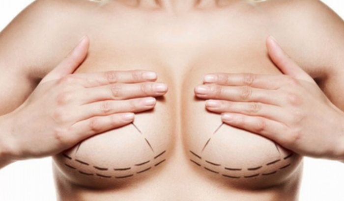 Vaquinha Mamoplastia