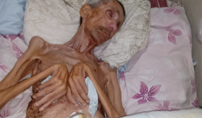 Renato Siqueira da Silva esta acamado e precisa de cuidados especiais 