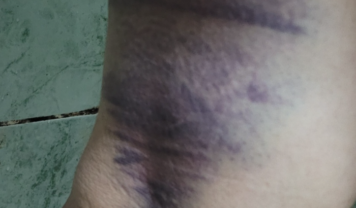 Tratamento da Lesão