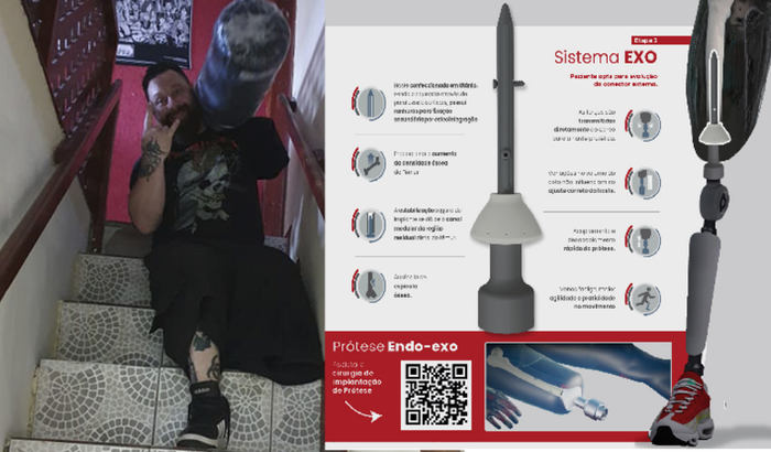 Cirurgia de Osseointegração para voltar a andar sem dores