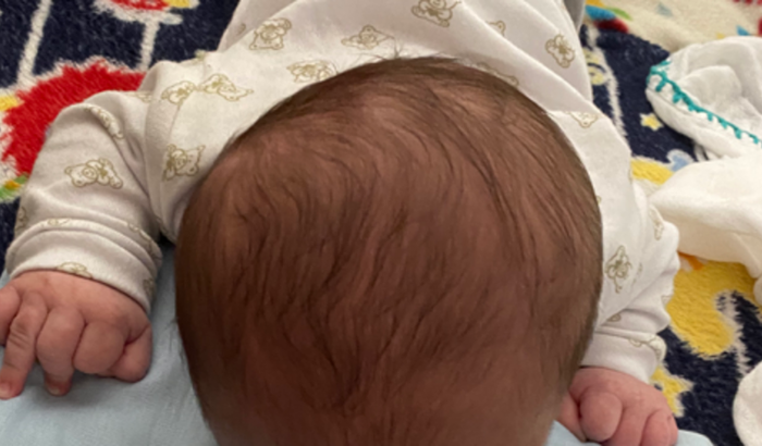 Tratamento de Assimetria Craniana do Bebê Fernando