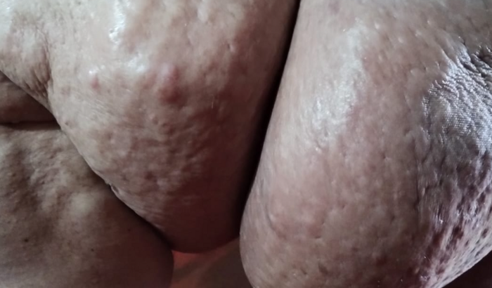 Cirurgia de LIPOMA GIGANTE