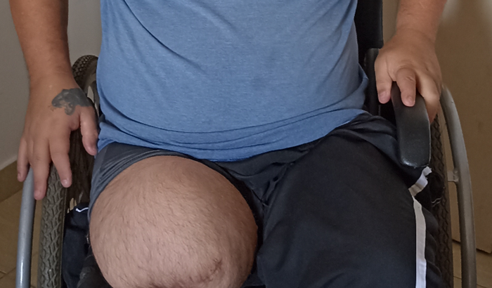 Prótese 🦿 Transfemural