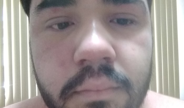 DERMATITE ATÓPICA - JOÃO VITOR