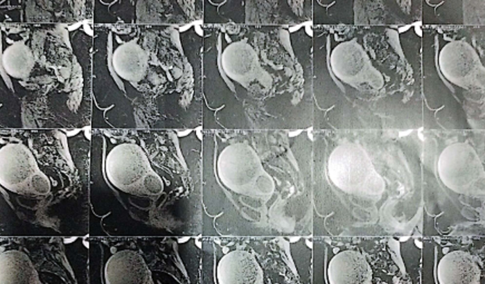 Cirurgia de retirada de mioma gigante .